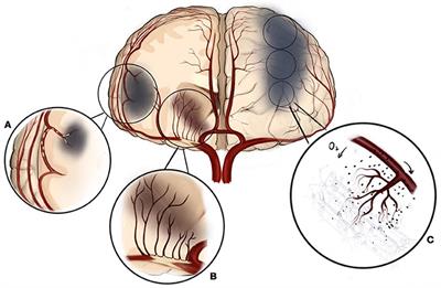 Endovascular Treatment of Intracranial Atherosclerotic Stenosis: Current Debates and Future Prospects